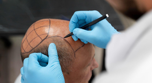 Implante ou transplante capilar? Entenda as principais diferenças