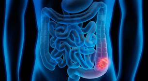 Atividade física ajudaria a reduzir crescimento de células do câncer de cólon