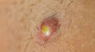 Qual o papel das bactérias na formação de furúnculos?