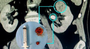 Nefrectomia robótica preserva rins com alta precisão