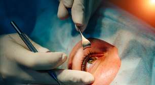 Cirurgia de catarata evolui e amplia recuperação da visão