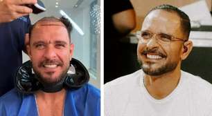 Diogo Nogueira raspa cabelo e fãs suspeitam de possível transplante capilar; veja