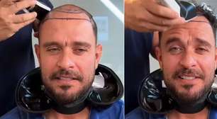Diogo Nogueira raspa o cabelo e levanta suspeita de novo transplante capilar; especialista detalha procedimento, cada vez mais popular em famosos: 'Deixou de ser tabu'