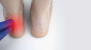 Dor no pé ao acordar? Entenda a fascite plantar e como tratá-la com segurança