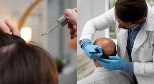 Minoxidil x implante capilar: qual é a melhor opção para queda de cabelo?