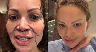 Solange Almeida passa por cirurgia delicada e especialista alerta: 'Não responde bem'