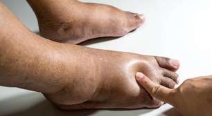 Diabetes e saúde dos pés: cuidados diários simples podem prevenir feridas, infecções e complicações graves