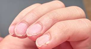 O que o formato das suas unhas revela sobre a falta de vitaminas