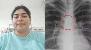 Jovem descobre que piercing de nariz perdido foi parar dentro dos seus pulmões