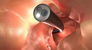 Adeus colonoscopia: avanço científico revela um novo caminho promissor para identificar problemas graves no intestino de forma simples