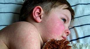 Queda da cobertura vacinal gera alerta para volta do sarampo