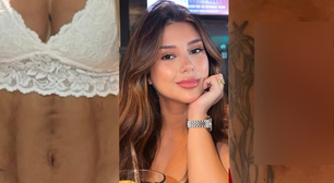 IMAGENS FORTES! Influenciadora mostra corpo necrosado após cirurgias plásticas em clínica queridinha das famosas: 'Sentia nojo de mim'