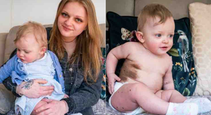 Bebê nasce com doença rara que provoca manchas dolorosas na pele