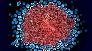 Paciente alcança remissão do HIV após transplante inédito de medula óssea de seu irmão