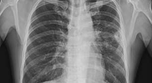 O que é neoplasia? Entenda a diferença entre tumores benignos e câncer de forma simples e confiável