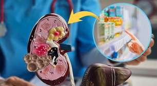 Médico aponta qual o pior inimigo da saúde do fígado e não é a gordura