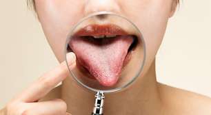 Língua branca? Saiba o que a cor da sua boca revela sobre sua saúde