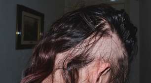 Nem estresse, nem falta de vitaminas: este é o sinal definitivo de que a sua queda de cabelo deixou de ser normal e exige um médico