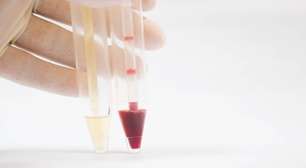 Urina vermelha: quando a mudança de cor é inofensiva e quando pode indicar problemas de saúde