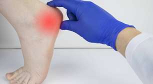 Esporão no calcanhar: o que é, por que causa dor ao pisar e quais são os tratamentos mais eficazes segundo a medicina