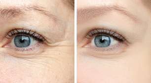Saiba como evitar rugas e outros problemas na região dos olhos