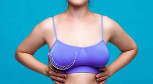 O que é ptose mamária? Cirurgião plástico esclarece