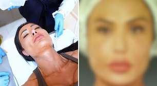 Gracyanne Barbosa faz procedimento invasivo no rosto: 'Não quero mais'