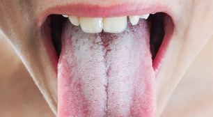 O mistério da língua esbranquiçada: causas, cuidados e quando se preocupar de verdade