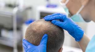 Medicina capilar avança e amplia possibilidade de tratamento