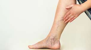 Por que o mau funcionamento intestinal pode ser o culpado de suas varizes?