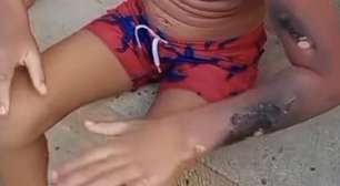 Menino de 6 anos tem 15% do corpo queimado após celular explodir ao jogar videogame em PE