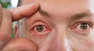 Olho vermelho ao acordar: causas como olho seco, alergias e ambiente explicadas de forma clara com sinais de alerta e cuidados básicos