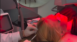 Virginia Fonseca revela volta de doença crônica: entenda o que é a alopecia areata e seus gatilhos