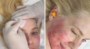 Virginia Fonseca reposta foto de 2023 para mostrar resultado de tratamento contra acne; veja