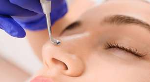 Cravos e espinhas: entenda como se formam dentro do poro e por que espremer pode piorar a inflamação da pele