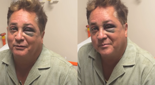 Leonardo sofre acidente e aparece com olho roxo nas redes sociais