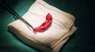 Por que o apêndice inflama com tanta facilidade? Entenda a apendicite, suas causas, sintomas, riscos e como ocorre o tratamento