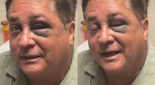 Leonardo surge com ferimento no rosto e revela o que aconteceu no Pantanal; saiba tudo