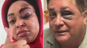 Ex-BBB Rízia Cerqueira brinca ao comparar olho roxo com Leonardo: 'Passada que estamos iguais'