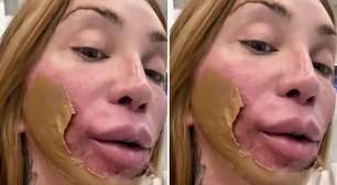 Maya Massafera faz procedimento que 'destrói a pele' para regenerá-la: 'Tira toda a pela'