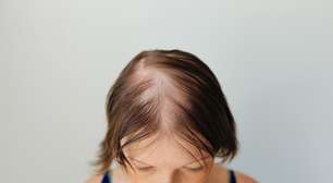 Calvície feminina: por que mais mulheres estão enfrentando o problema?