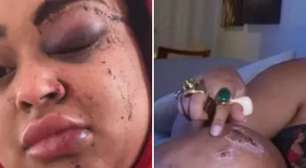 PESADELO! Ex-BBB sofre acidente grave e mostra hematomas severos: 'Arrebentada'