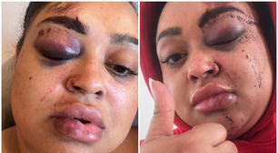 Ex-BBB Rízia Cerqueira detalha acidente com moto elétrica e mostra ferimentos: 'Fiquei arrebentada'