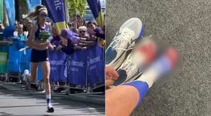 Atleta britânica revela lesão grave no pé após Maratona de Londres