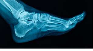 Como proteger seus pés: ortopedista alerta para riscos de traumas e desgaste natural