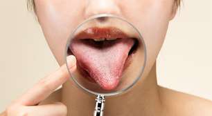 Língua branca ao acordar: é normal ou precisa de atenção?