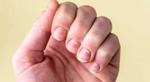 Manchas brancas nas unhas: por que a leuconíquia pontuada quase nunca indica falta de vitaminas ou cálcio