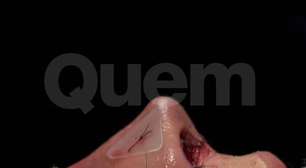 Antes e depois! Veja resultado da nova rinoplastia de 4 horas de Rafaella Justus