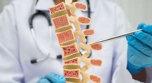 Osteoporose: médica alerta para sinais que surgem muito antes da primeira fratura