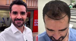 Marcelo Cosme, da GloboNews, mostra antes e depois de transplante capilar e celebra resultado; veja